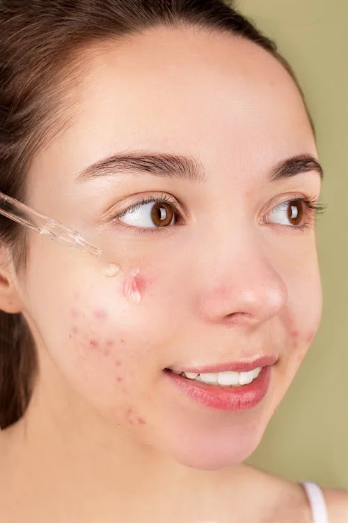 ব্রণ (Acne) Skincare in Bangladesh: Causes, Routine & Best Products