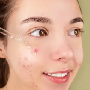 Young woman applying serum to acne-prone skin with a glass dropper.