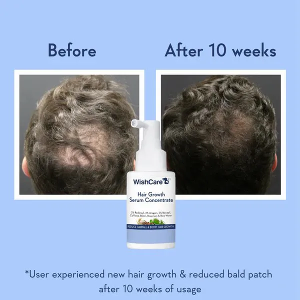 Top of a man's head before and after hair growth serum, showing reduced bald spot.